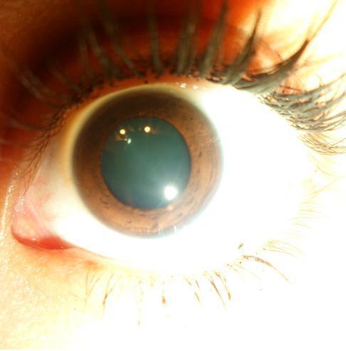 one pupil dilated one constricted