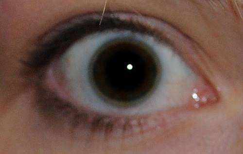 one pupil dilated suddenly