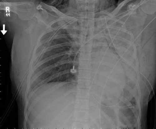 chest tube x ray